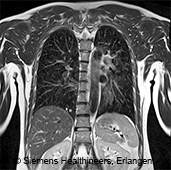 Magnetic resonance imaging of the lung