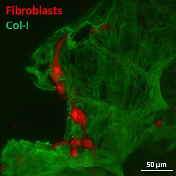 Mikroskopbild mit Lungengewebe grün und Fibroblasten in rot